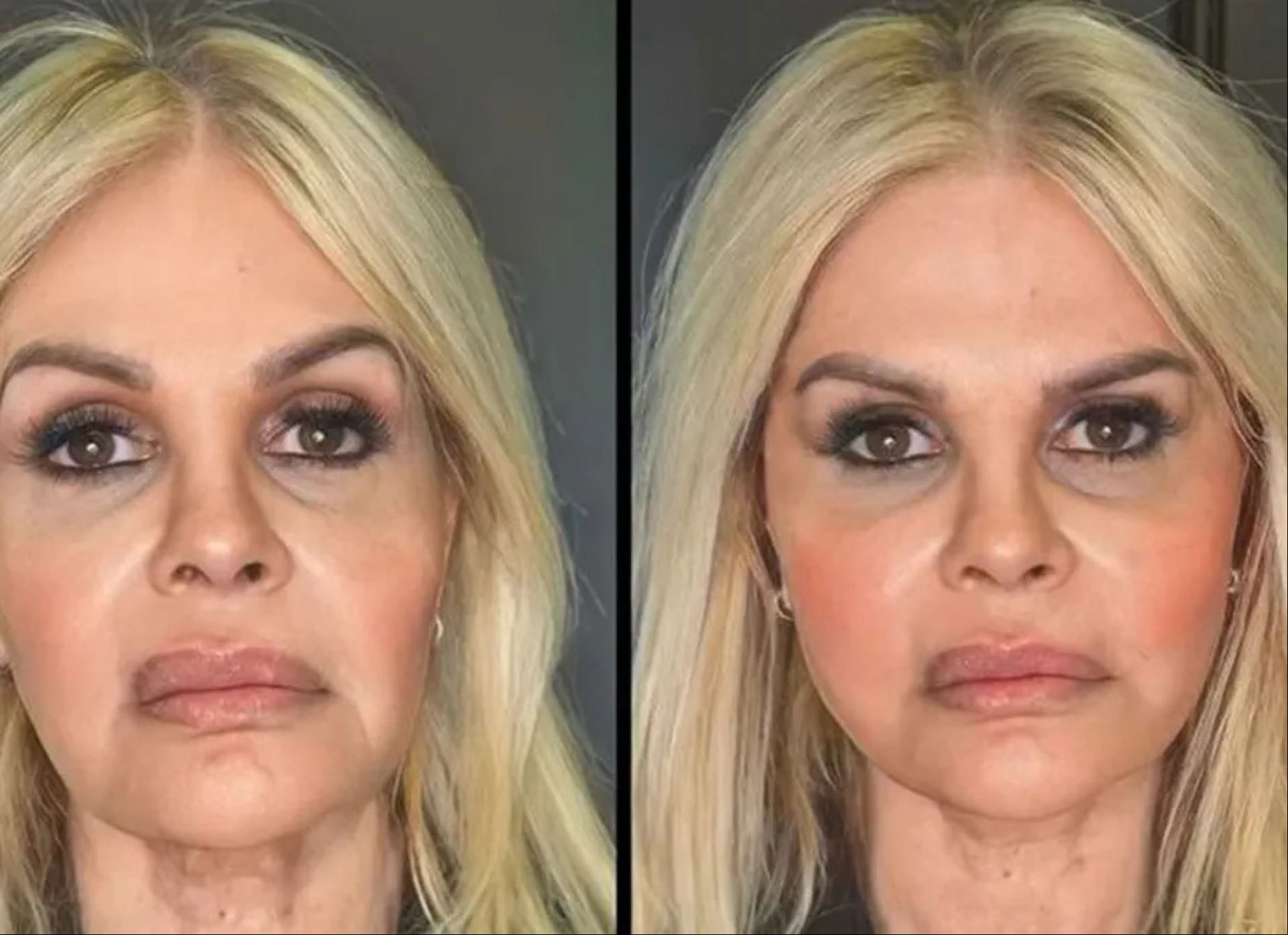 Monique Evans divulga antes e depois de harmonização facial Monique Evans divulga antes e depois de harmonização facial