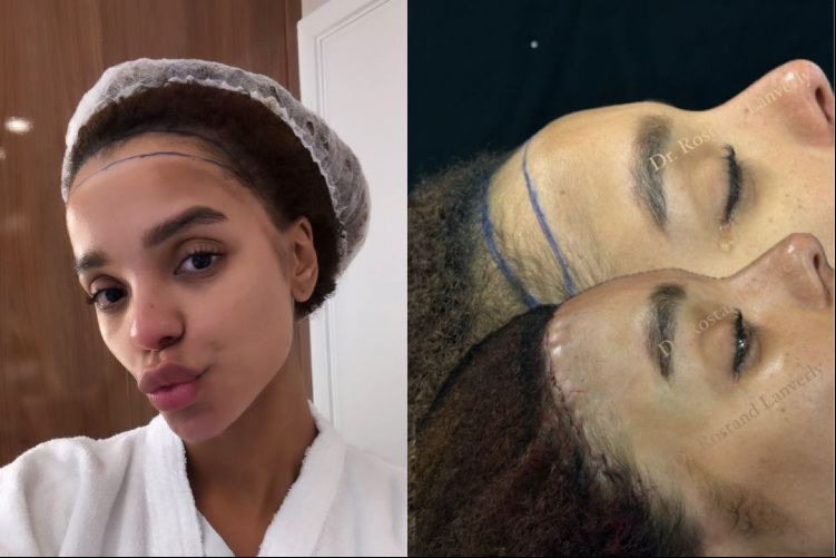 Ex-BBB e esposa de Ludmilla, a bailarina Brunna Gonçalves chamou a atenção nas redes sociais por polêmica cirurgia estética no rosto