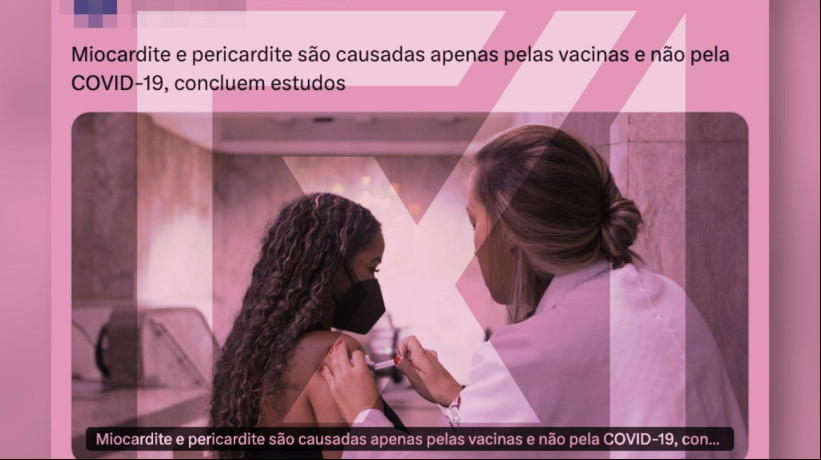 Miocardite e pericardite sÃ£o condiÃ§Ãµes caracterizadas pela inflamaÃ§Ã£o do mÃºsculo cardÃ­aco e inflamaÃ§Ã£o do revestimento externo do coraÃ§Ã£o 