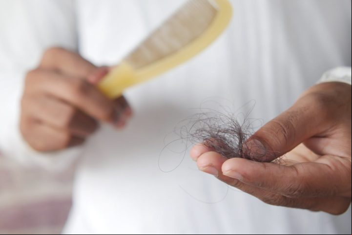 O medicamento não recupera o cabelo perdido, mas age como um botão de pausa para desacelerar a queda.