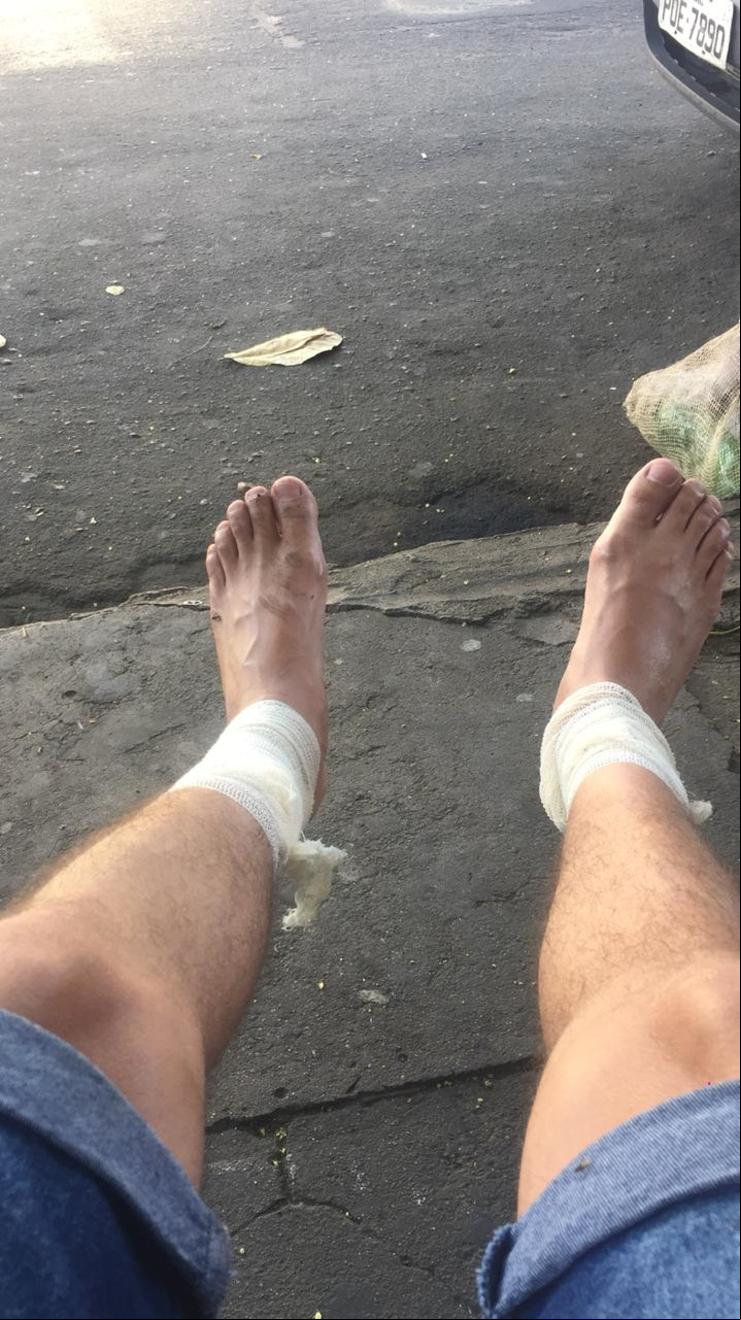 Pernas com curativo de um dos feridos no caso 